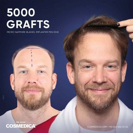 Before and after results of a hair transplant in Turkey at Cosmedica Clinic ©Cosmedica Clinic 